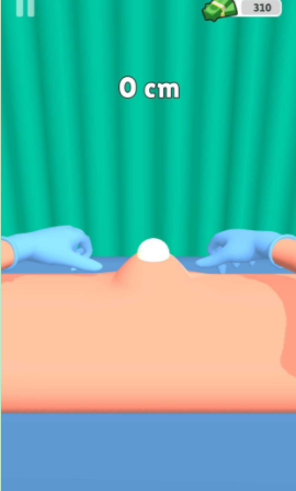 粉刺挤压 粉刺挤压